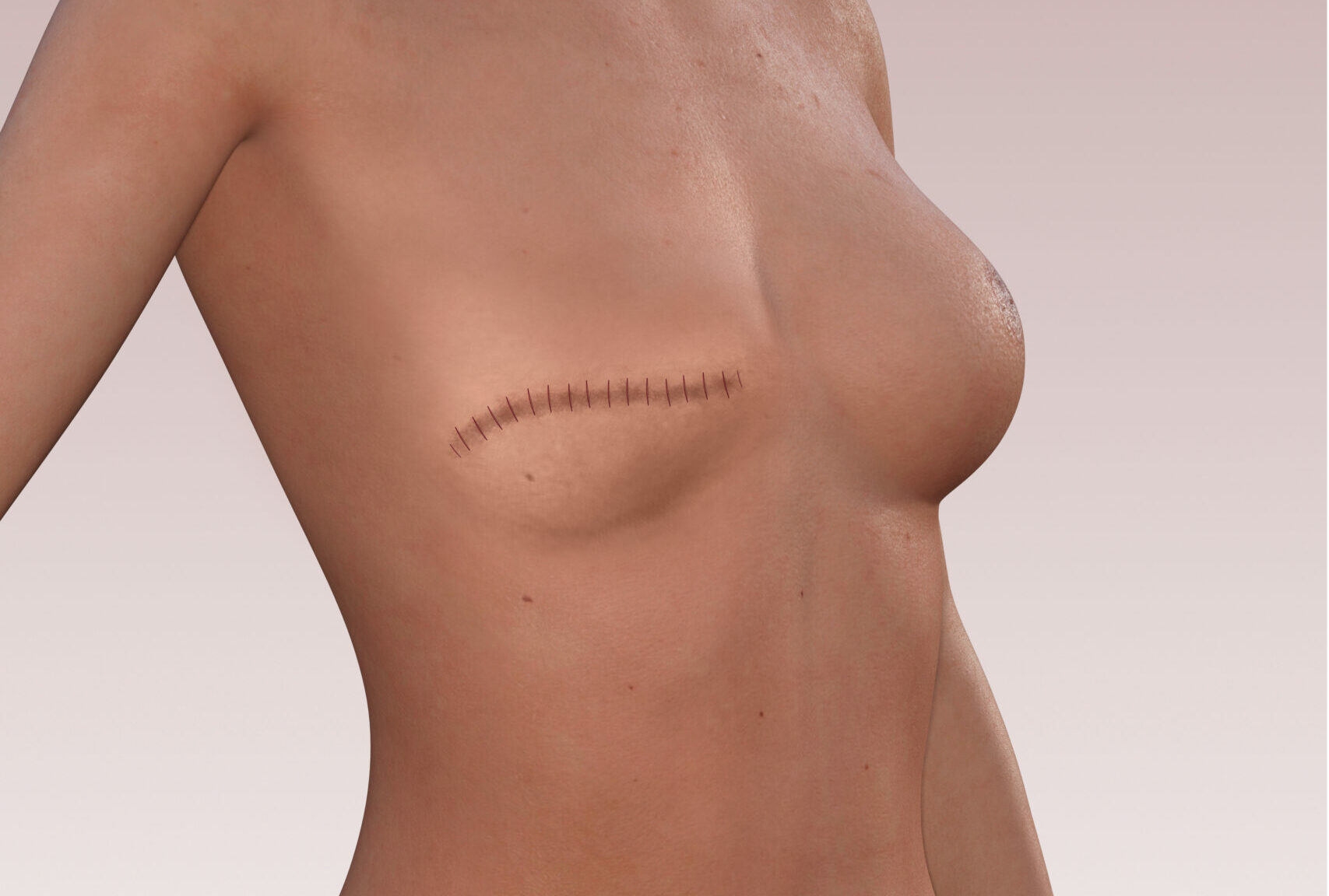 dermopigmentation reparatrice - cicatrices mammaires